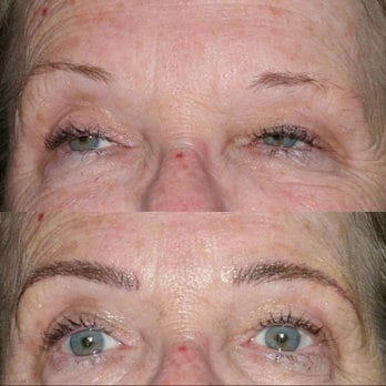 Veonne™ Micro-Infusion Brow Kit